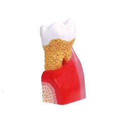 Lower Molar With Caries